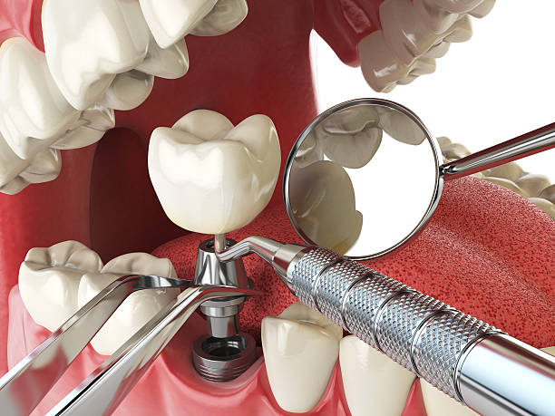 Best Emergency Treatment for Dental Infections or Abscesses in Live Oak, FL